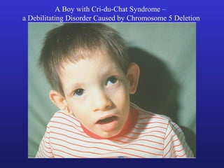 A Boy with Cri-du-Chat Syndrome –
a Debilitating Disorder Caused by Chromosome 5 Deletion
 