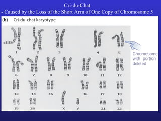 Cri-du-Chat
- Caused by the Loss of the Short Arm of One Copy of Chromosome 5
 