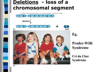 Deletions - loss of a
chromosomal segment
Eg.
Prader-Willi
Syndrome
Cri du Chat
Syndrome
 