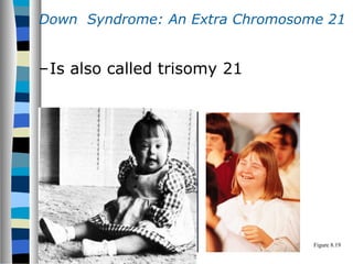 Down Syndrome: An Extra Chromosome 21
–Is also called trisomy 21
Figure 8.19
 