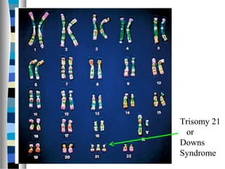 Trisomy 21
or
Downs
Syndrome
 