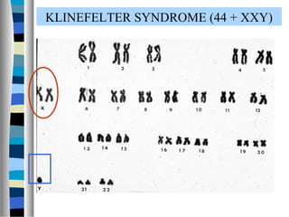KLINEFELTER SYNDROME (44 + XXY)
 