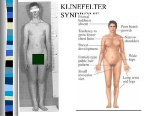 KLINEFELTER
SYNDROME
 
