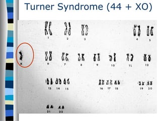 Turner Syndrome (44 + XO)
 
