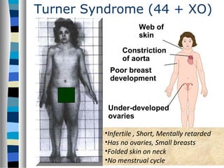 Turner Syndrome (44 + XO)
Constriction
of aorta
(b) A woman with Turner
syndrome (XO)
Poor breast
development
Web of
skin
Under-developed
ovaries
•Infertile , Short, Mentally retarded
•Has no ovaries, Small breasts
•Folded skin on neck
•No menstrual cycle
 