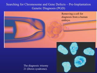 Searching for Chromosome and Gene Defects – Pre-Implantation
Genetic Diagnosis (PGD)
Removing a cell for
diagnosis from a human
embryo.
The diagnosis: trisomy
21 (Down syndrome).
 