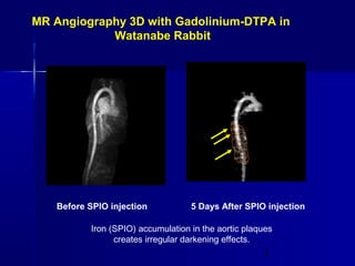 1
MR Angiography 3D with Gadolinium-DTPA in
Watanabe Rabbit
Before SPIO injection 5 Days After SPIO injection
Iron (SPIO) accumulation in the aortic plaques
creates irregular darkening effects.
 