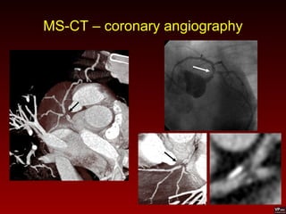 MS-CT – coronary angiography
 