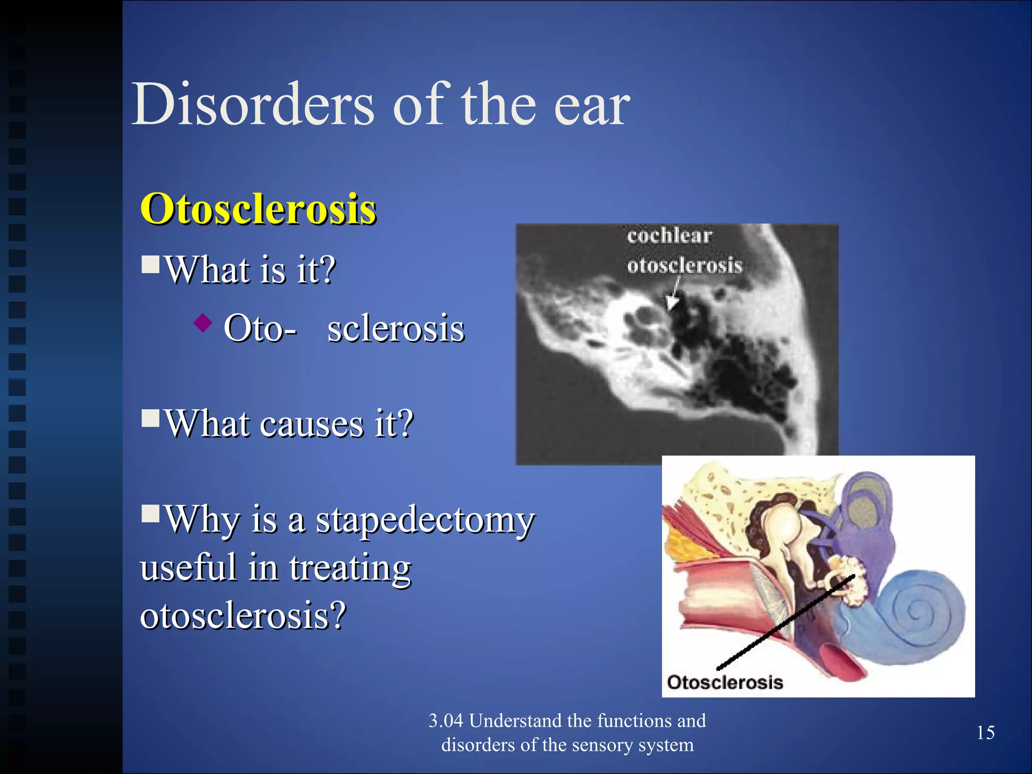 Disorders of the ear
OtosclerosisOtosclerosis
What is it?What is it?
 Oto- sclerosisOto- sclerosis
What causes it?What causes it?
Why is a stapedectomyWhy is a stapedectomy
useful in treatinguseful in treating
otosclerosis?otosclerosis?
3.04 Understand the functions and
disorders of the sensory system
15
 