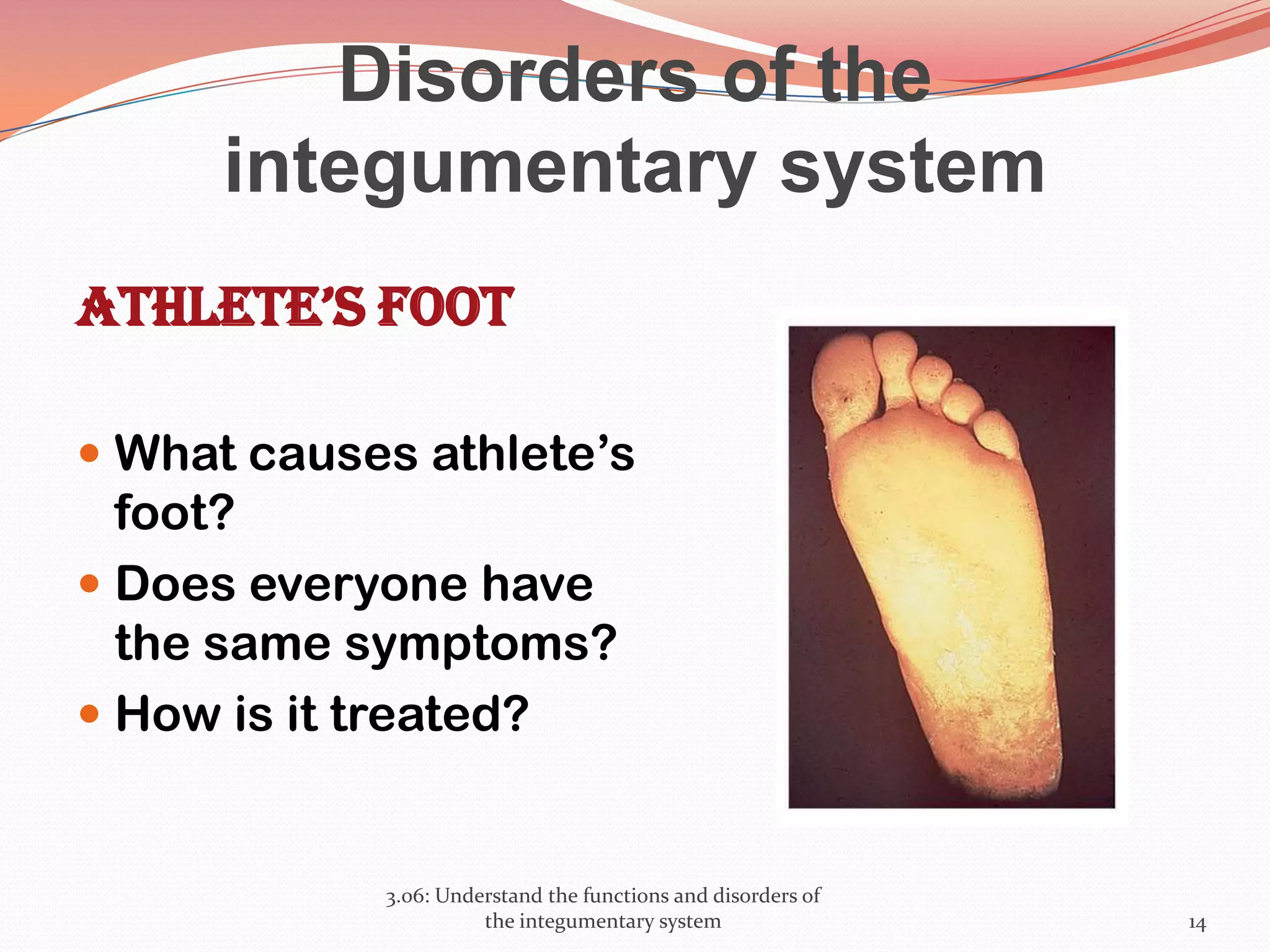 Disorders of the
integumentary system
Athlete’s foot
 What causes athlete’s
foot?
 Does everyone have
the same symptoms?
 How is it treated?
3.06: Understand the functions and disorders of
the integumentary system 14
 