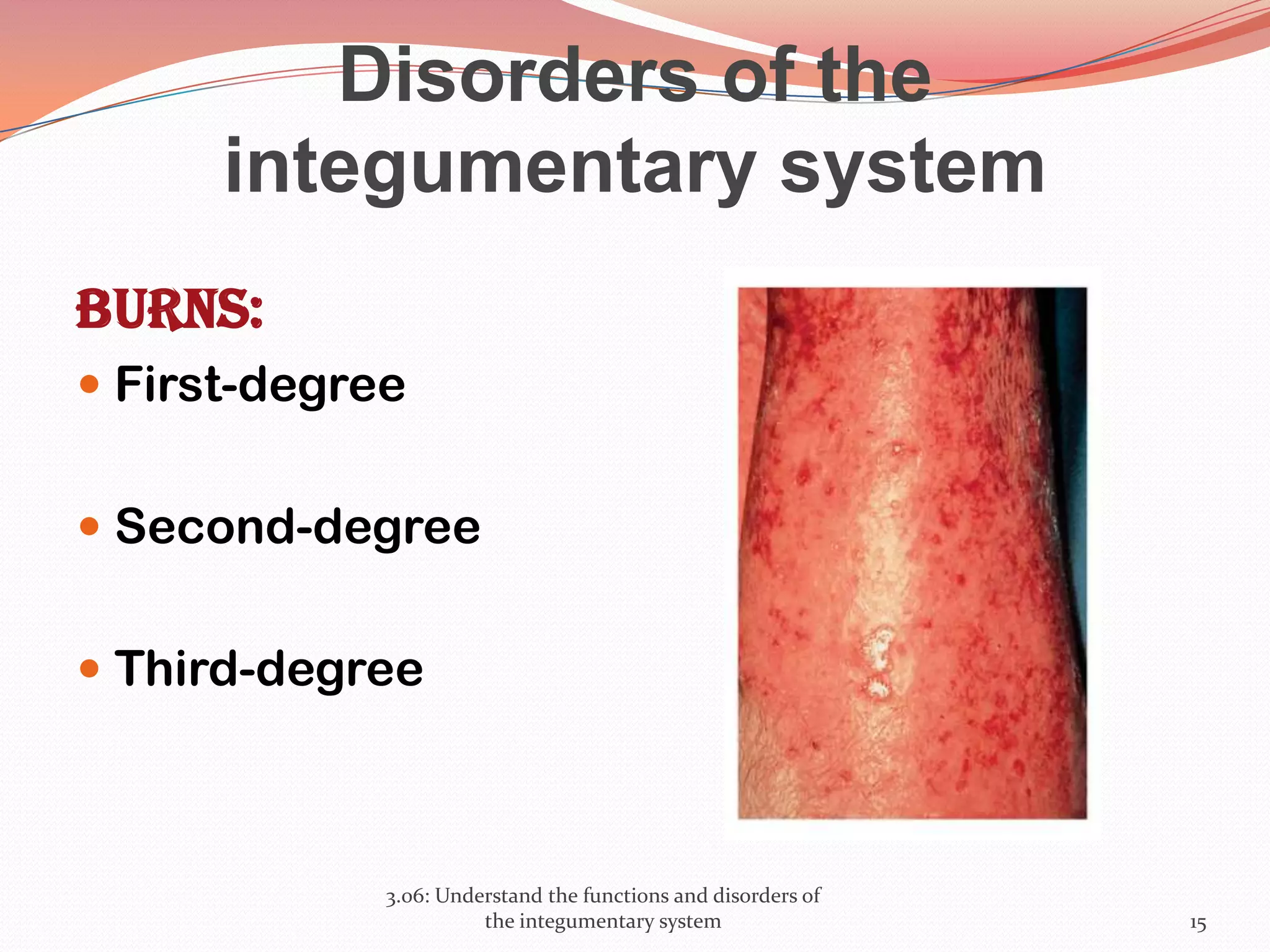 Disorders of the
integumentary system
Burns:
 First-degree
 Second-degree
 Third-degree
3.06: Understand the functions and disorders of
the integumentary system 15
 