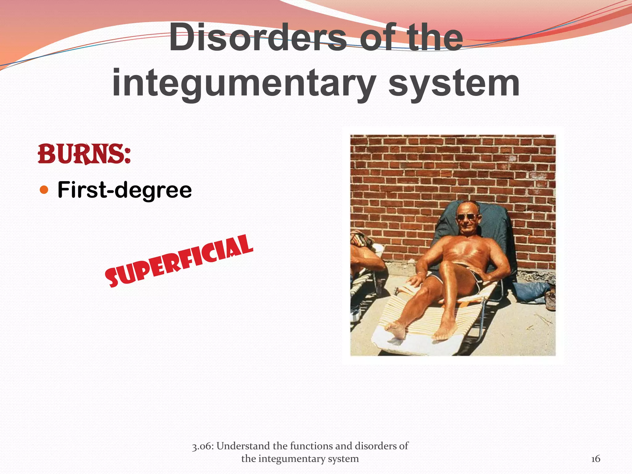 Disorders of the
integumentary system
Burns:
 First-degree
3.06: Understand the functions and disorders of
the integumentary system 16
 