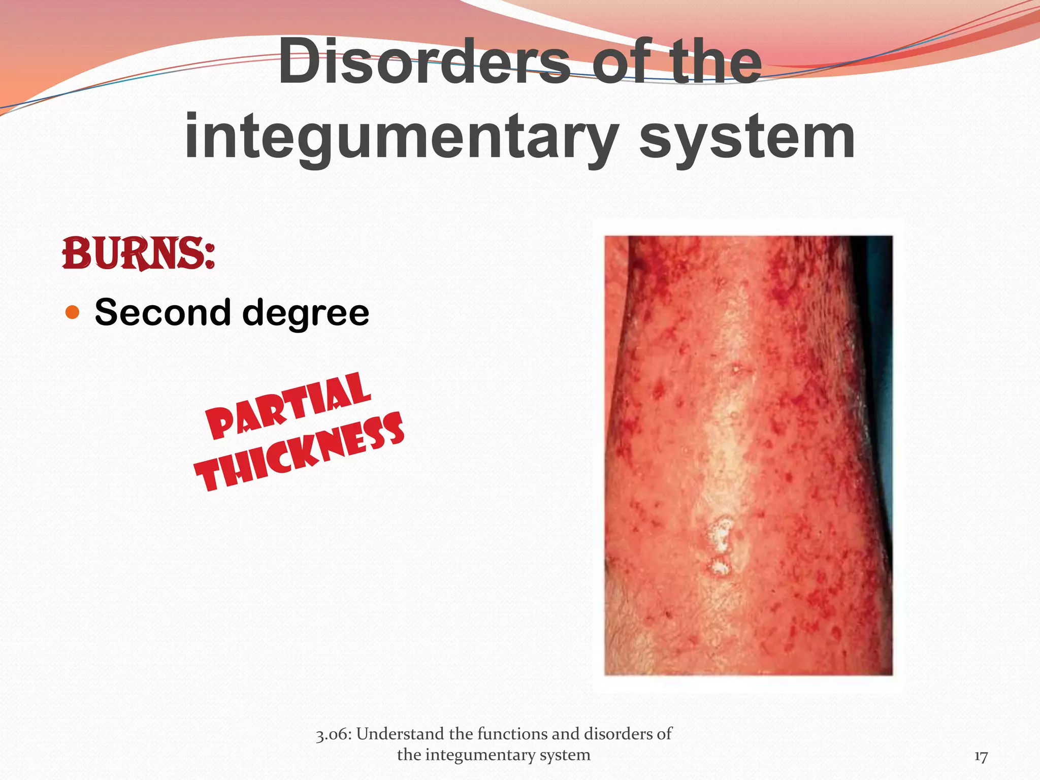 Disorders of the
integumentary system
Burns:
 Second degree
3.06: Understand the functions and disorders of
the integumentary system 17
 