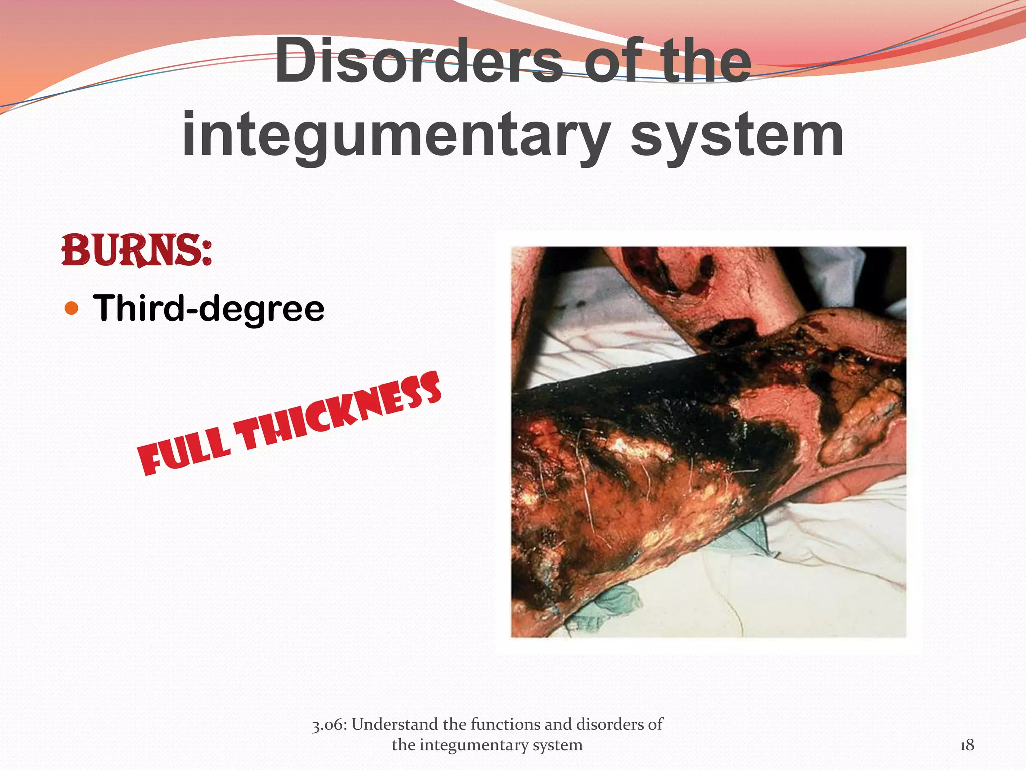 Disorders of the
integumentary system
Burns:
 Third-degree
3.06: Understand the functions and disorders of
the integumentary system 18
 