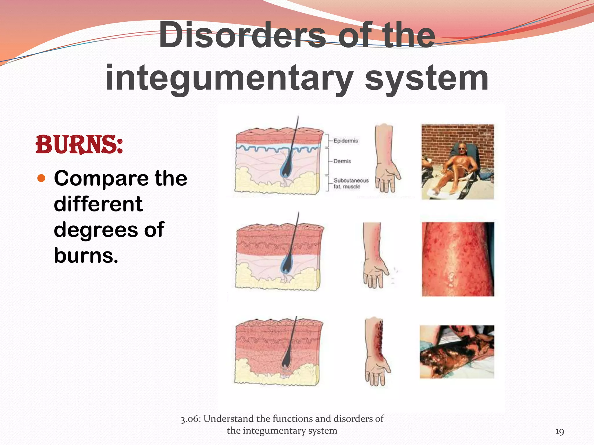 Disorders of the
integumentary system
Burns:
 Compare the
different
degrees of
burns.
3.06: Understand the functions and disorders of
the integumentary system 19
 