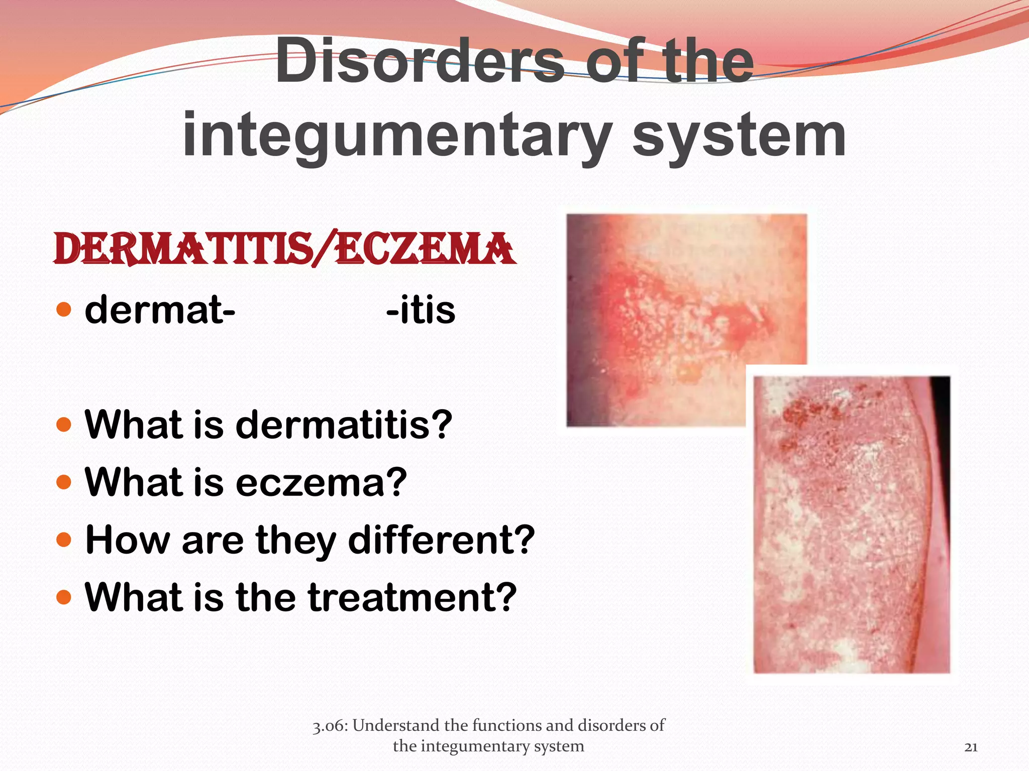 Disorders of the
integumentary system
Dermatitis/Eczema
 dermat- -itis
 What is dermatitis?
 What is eczema?
 How are they different?
 What is the treatment?
3.06: Understand the functions and disorders of
the integumentary system 21
 
