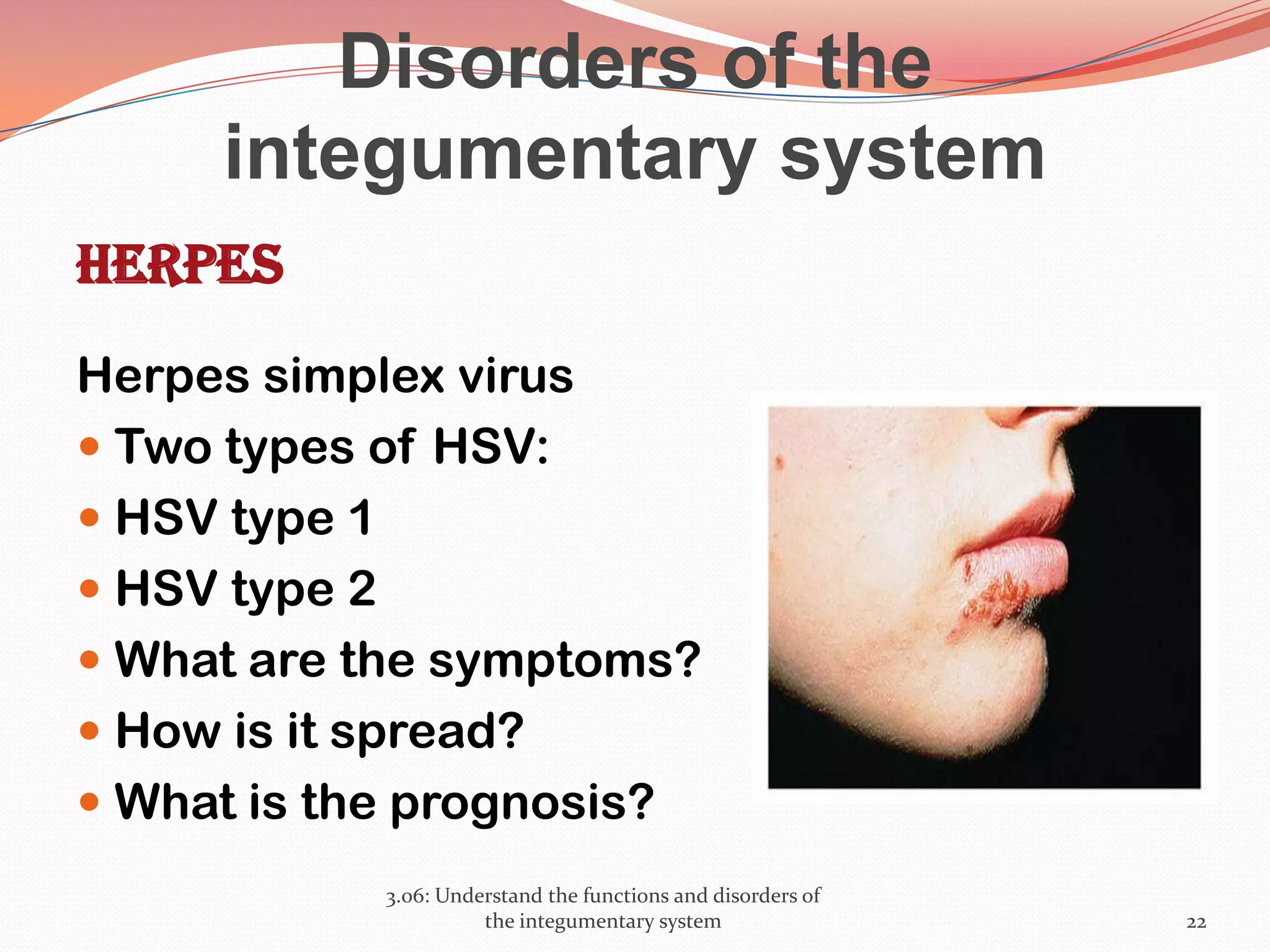 Disorders of the
integumentary system
Herpes
Herpes simplex virus
 Two types of HSV:
 HSV type 1
 HSV type 2
 What are the symptoms?
 How is it spread?
 What is the prognosis?
3.06: Understand the functions and disorders of
the integumentary system 22
 
