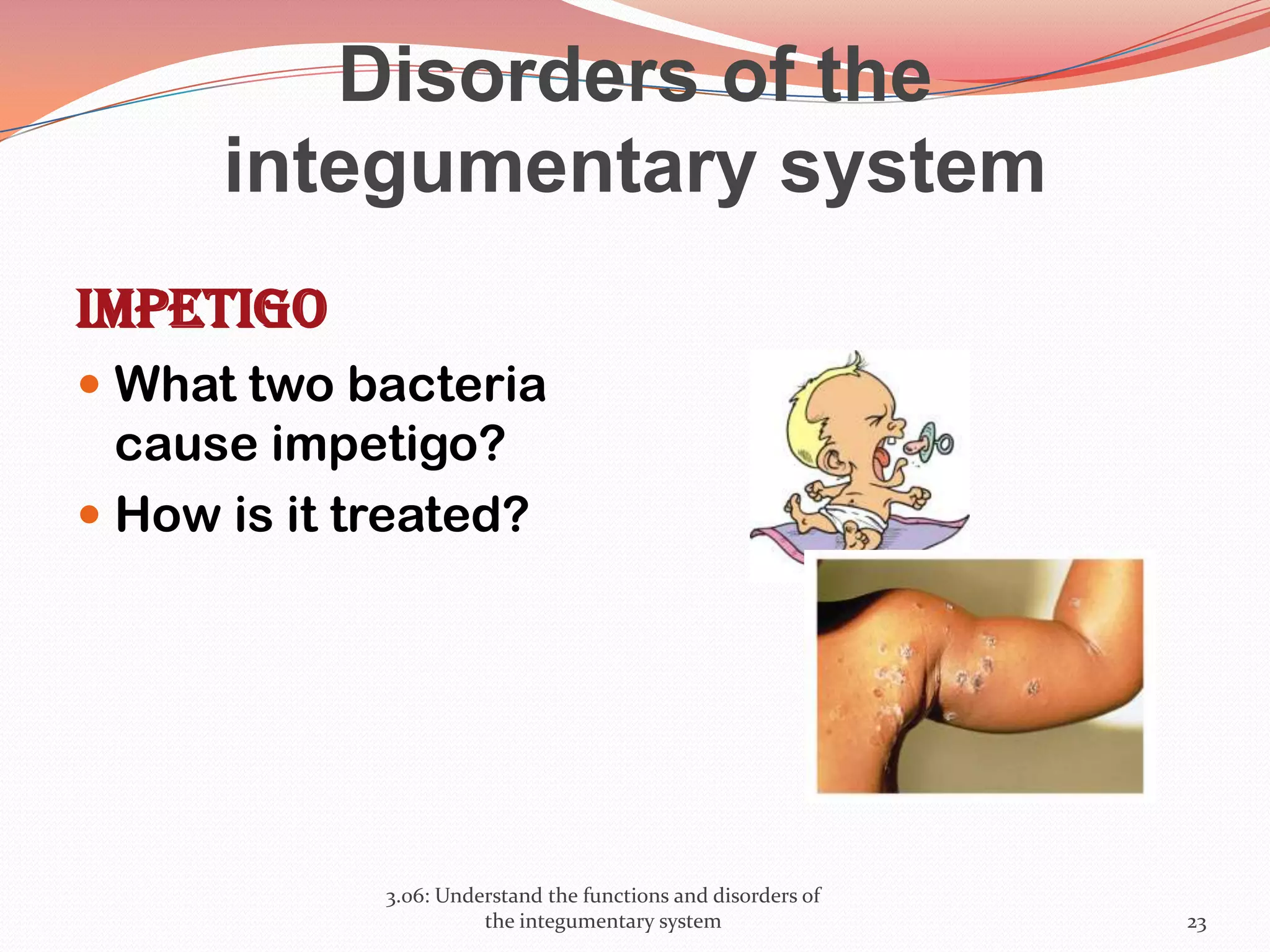 Disorders of the
integumentary system
Impetigo
 What two bacteria
cause impetigo?
 How is it treated?
3.06: Understand the functions and disorders of
the integumentary system 23
 
