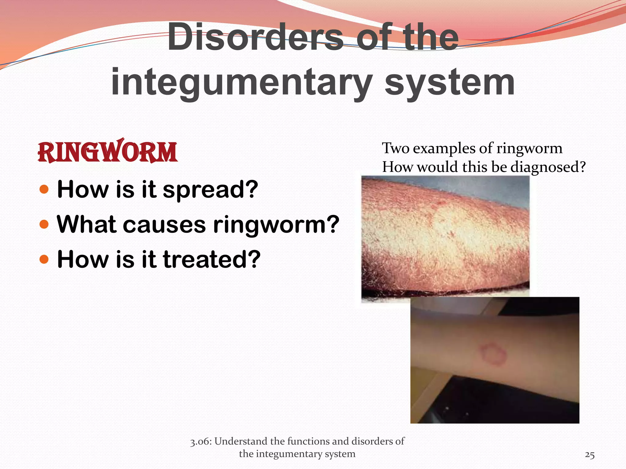Disorders of the
integumentary system
Ringworm
 How is it spread?
 What causes ringworm?
 How is it treated?
3.06: Understand the functions and disorders of
the integumentary system 25
Two examples of ringworm
How would this be diagnosed?
 