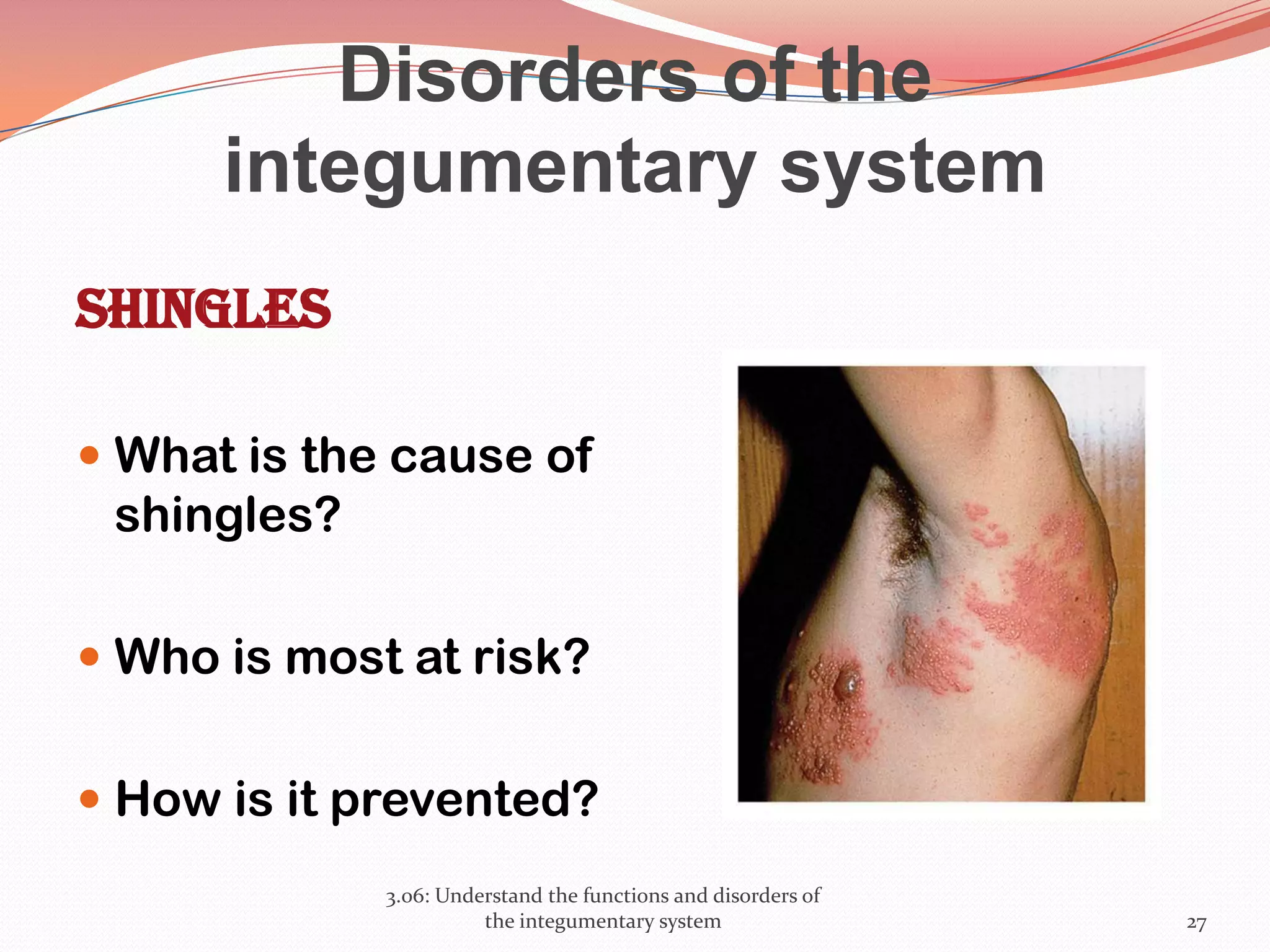 Disorders of the
integumentary system
Shingles
 What is the cause of
shingles?
 Who is most at risk?
 How is it prevented?
3.06: Understand the functions and disorders of
the integumentary system 27
 