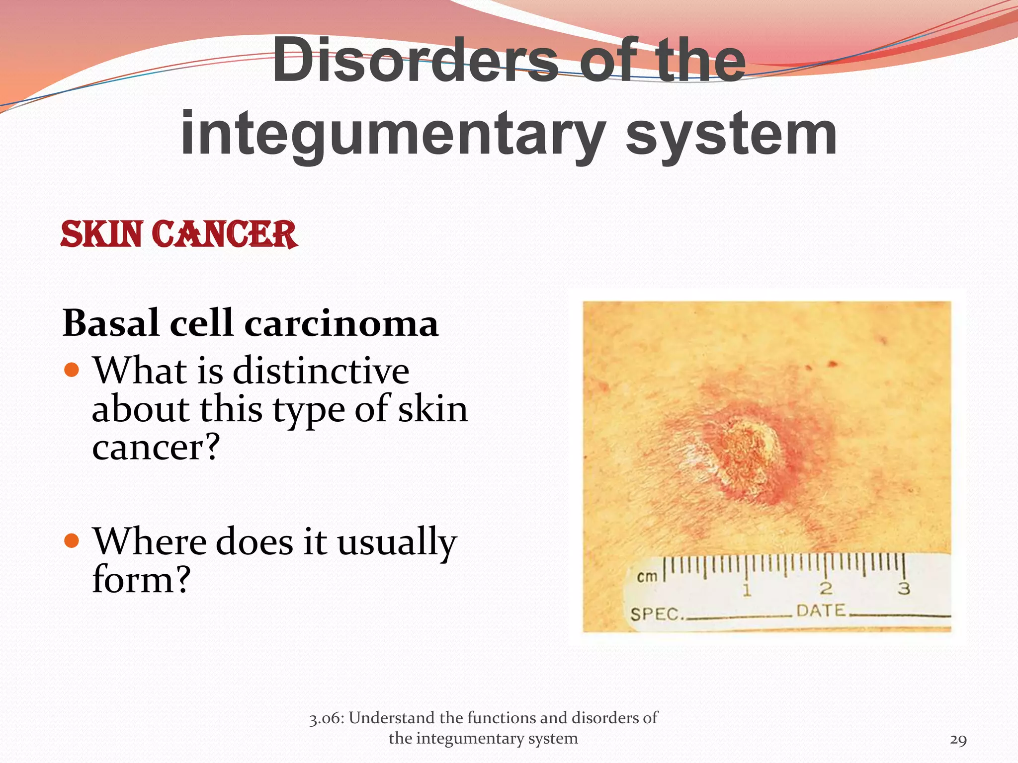 Disorders of the
integumentary system
Skin cancer
Basal cell carcinoma
 What is distinctive
about this type of skin
cancer?
 Where does it usually
form?
3.06: Understand the functions and disorders of
the integumentary system 29
 