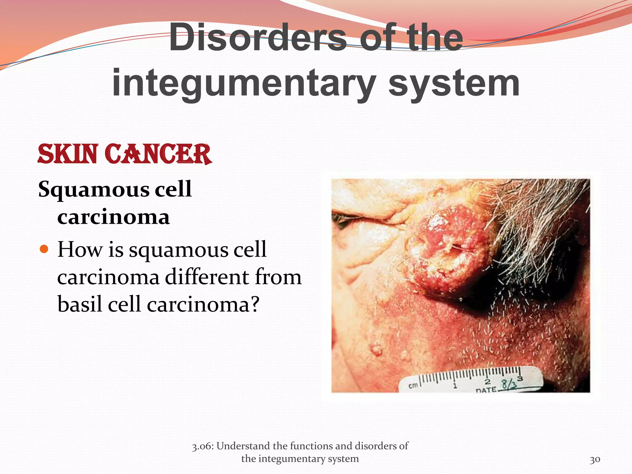 Disorders of the
integumentary system
Skin Cancer
Squamous cell
carcinoma
 How is squamous cell
carcinoma different from
basil cell carcinoma?
3.06: Understand the functions and disorders of
the integumentary system 30
 