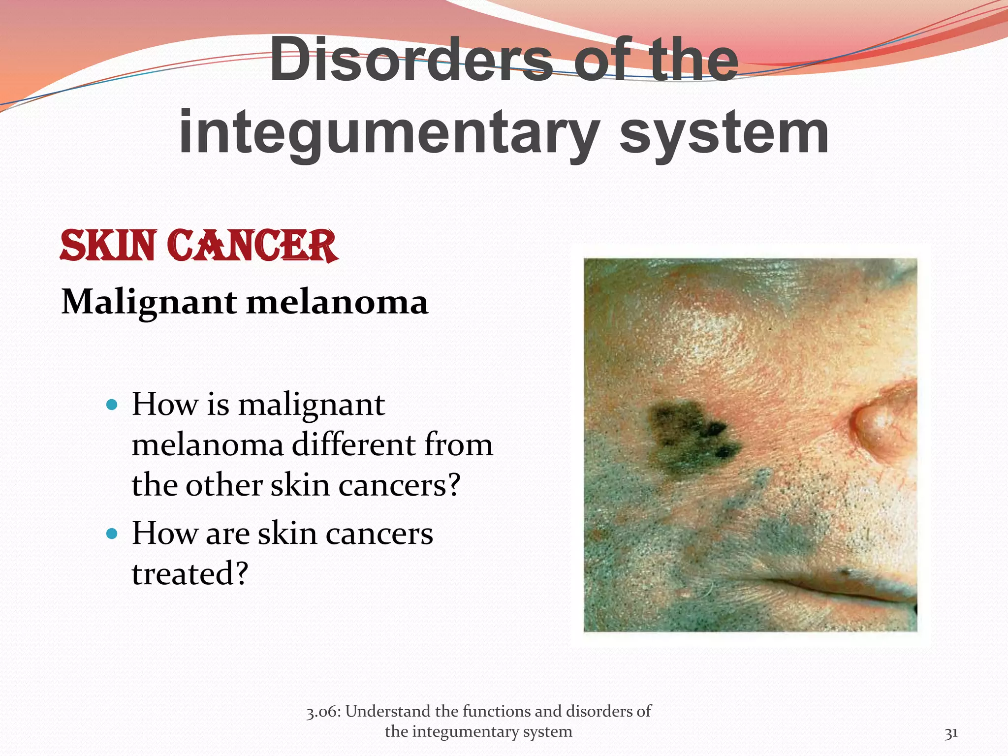 Disorders of the
integumentary system
Skin cancer
Malignant melanoma
 How is malignant
melanoma different from
the other skin cancers?
 How are skin cancers
treated?
3.06: Understand the functions and disorders of
the integumentary system 31
 