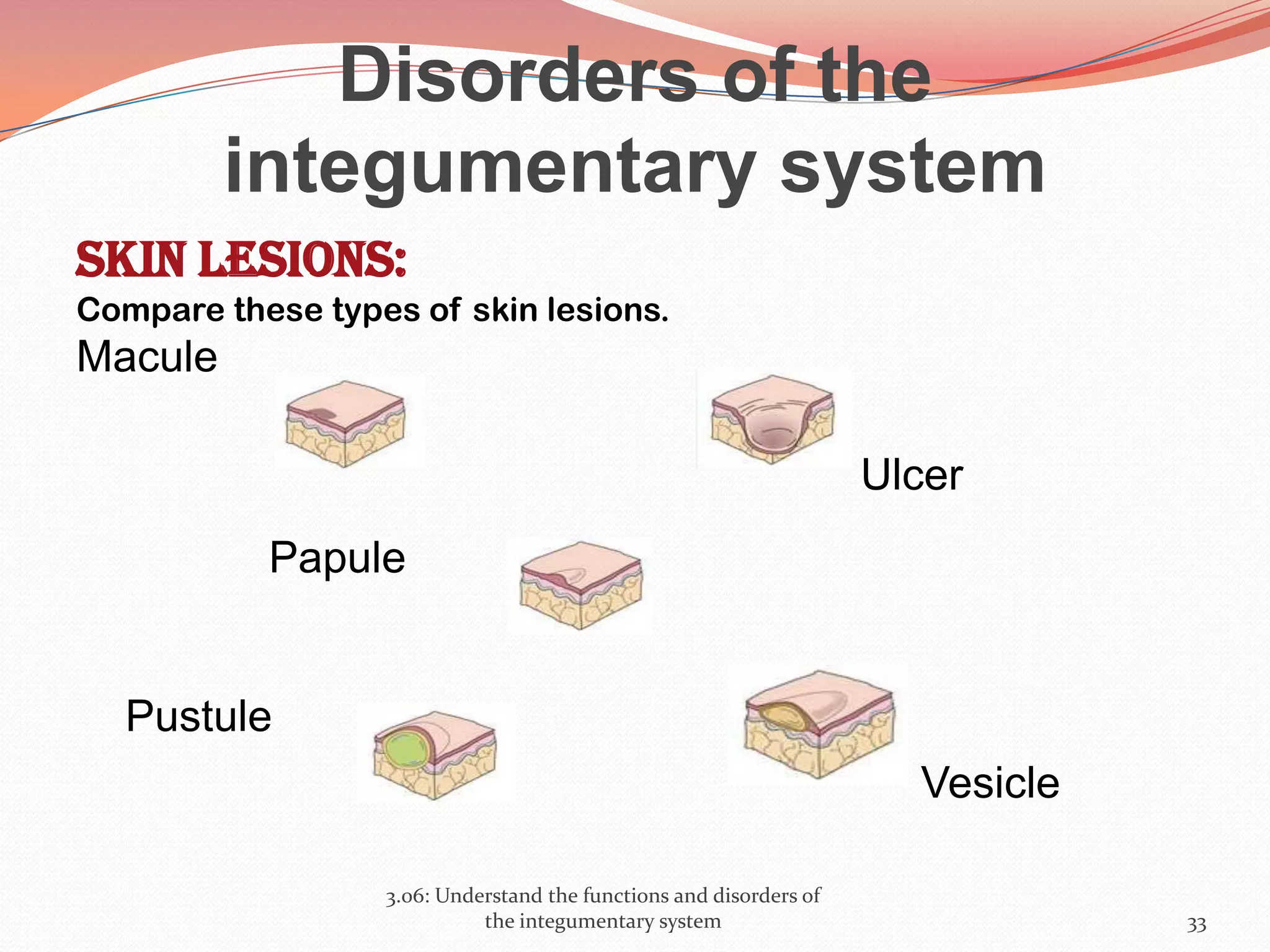 Disorders of the
integumentary system
Skin lesions:
Compare these types of skin lesions.
Macule
Papule
Pustule
3.06: Understand the functions and disorders of
the integumentary system 33
Vesicle
Ulcer
 