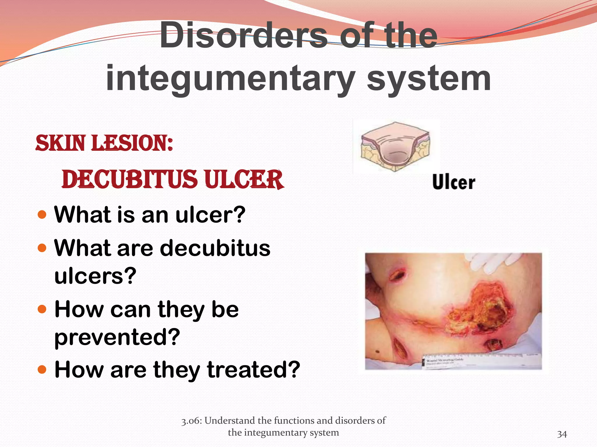 Disorders of the
integumentary system
Skin lesion:
Decubitus ulcer
 What is an ulcer?
 What are decubitus
ulcers?
 How can they be
prevented?
 How are they treated?
3.06: Understand the functions and disorders of
the integumentary system 34
 