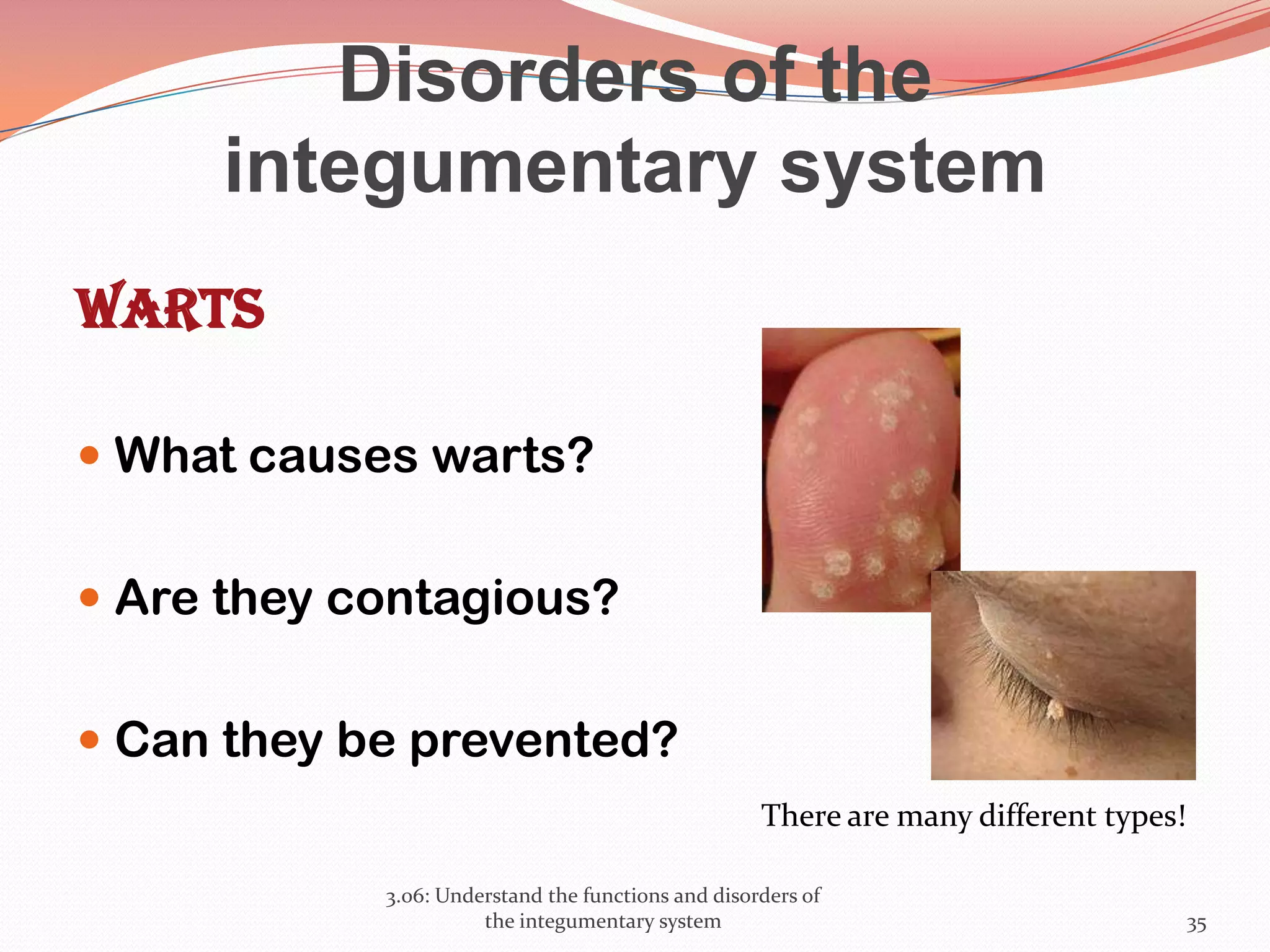 Disorders of the
integumentary system
warts
 What causes warts?
 Are they contagious?
 Can they be prevented?
3.06: Understand the functions and disorders of
the integumentary system 35
There are many different types!
 