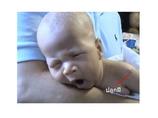 ปลูกฝี 