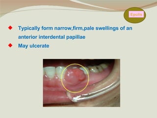 Epulis Typically form narrow,firm,pale swellings of an anterior interdental papillae May ulcerate 