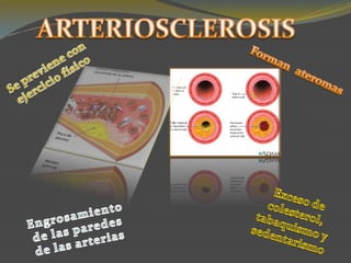 ARTERIOSCLEROSIS Formanateromas Se previene con ejercicio físico Exceso de colesterol, tabaquismo y sedentarismo  Engrosamiento de las paredes  de las arterias 