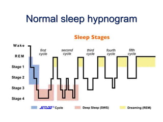 Normal sleep hypnogram
 