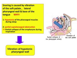Snoring is caused by vibration
of the soft palate , lateral
pharyngeal wall & base of the
tongue WHY?
1- Hypotonia of the pharyngeal muscles
during sleep
2- partial supralaryngeal obstruction
 Partial collapse of the oropharynx during
inspiration
Vibration of hypotonic
pharyngeal wall
 