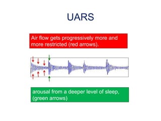 UARS
Air flow gets progressively more and
more restricted (red arrows).
arousal from a deeper level of sleep,
(green arrows)
 