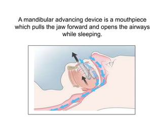 A mandibular advancing device is a mouthpiece
which pulls the jaw forward and opens the airways
while sleeping.
 
