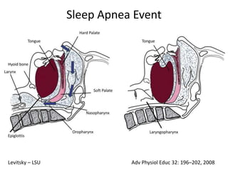 Adv Physiol Educ 32: 196–202, 2008Levitsky – LSU
Sleep Apnea Event
 