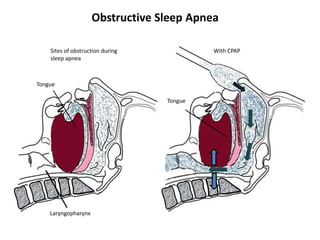 Sites of obstruction during
sleep apnea
Laryngopharynx
With CPAP
Tongue
Tongue
Obstructive Sleep Apnea
 