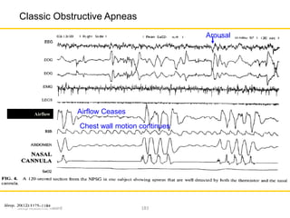 Sleep Academic Award 183
Classic Obstructive Apneas
Airflow Airflow Ceases
Chest wall motion continues
Arousal
 