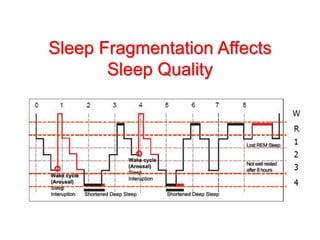 Sleep Fragmentation Affects
Sleep Quality
 