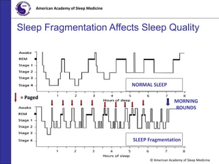 © American Academy of Sleep Medicine
American Academy of Sleep Medicine
Sleep Fragmentation Affects Sleep Quality
= Paged
NORMAL SLEEP
SLEEP Fragmentation
MORNING
ROUNDS
 