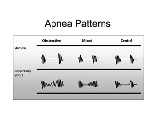 Apnea Patterns
Obstructive Mixed Central
Airflow
Respiratory
effort
 