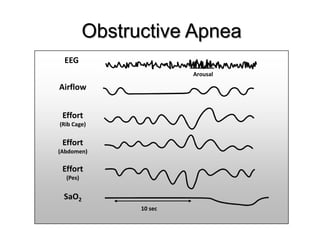 Obstructive Apnea
EEG
10 sec
Arousal
Airflow
Effort
(Pes)
SaO2
Effort
(Abdomen)
Effort
(Rib Cage)
 