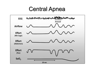 Central Apnea
10 sec
Arousal
EEG
Airflow
Effort
(Pes)
SaO2
Effort
(Abdomen)
Effort
(Rib Cage)
 
