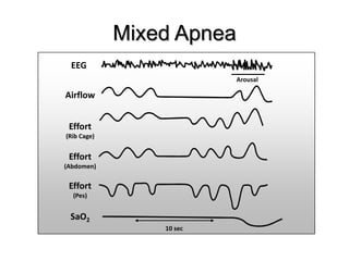 Mixed Apnea
EEG
10 sec
Arousal
Airflow
Effort
(Pes)
SaO2
Effort
(Abdomen)
Effort
(Rib Cage)
 