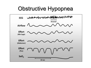 Obstructive Hypopnea
EEG
10 sec
Arousal
Airflow
Effort
(Pes)
SaO2
Effort
(Abdomen)
Effort
(Rib Cage)
 