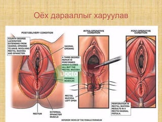 Оёх дарааллыг харуулав
 