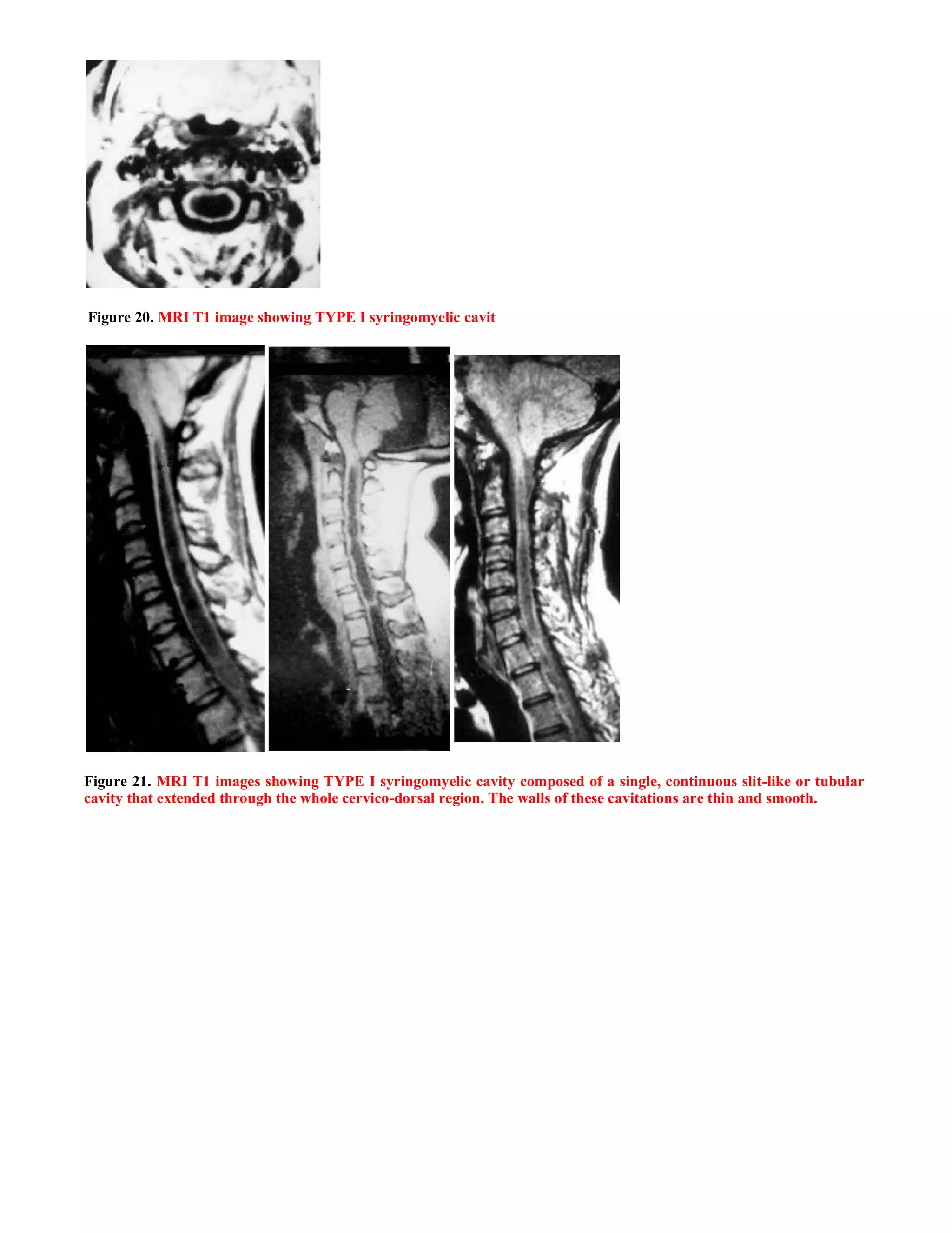 Case record...Congenital syringomyelia | PDF