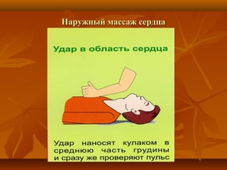 Наружный массаж сердца
 